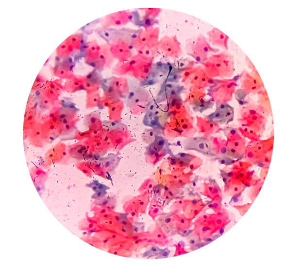 squamous cell Carcinoma treatment Costa Mesa CA