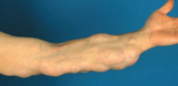 Mole and Cyst Removal: What to Expect from Long Beach Specialists